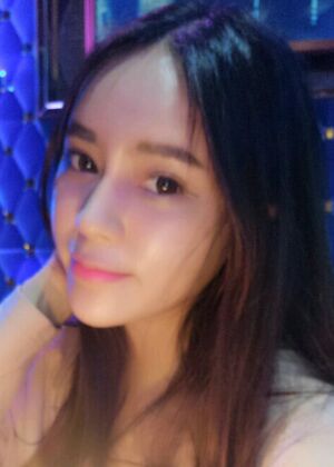 自体脂肪丰额头+苹果肌恢复两个月照片分享