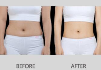 腰腹吸脂减肥对比图