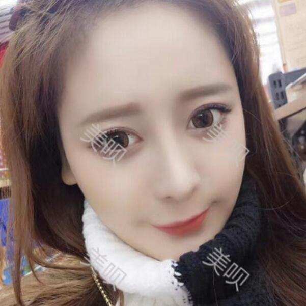 硅胶假体隆鼻+鼻翼缩小术后一个月恢复过程