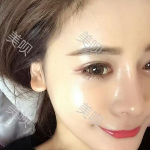 硅胶假体隆鼻+鼻翼缩小术后一个月恢复过程