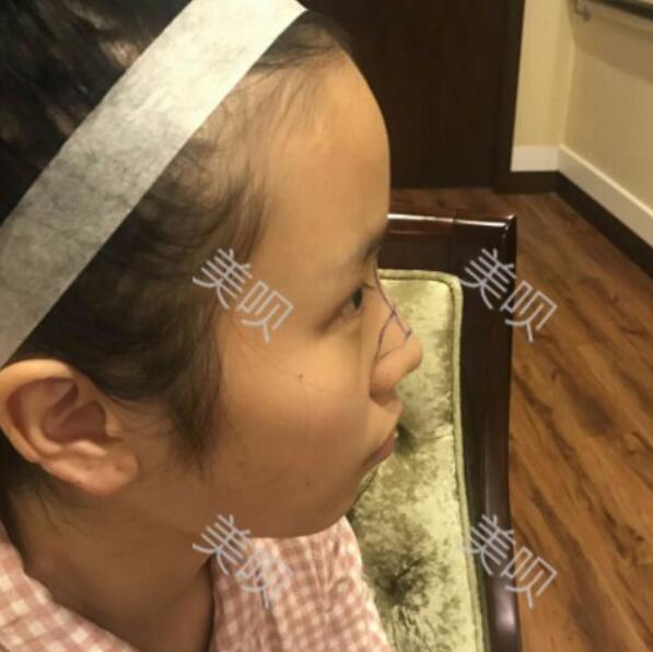 玻尿酸隆鼻前后对比照分享瞬间提升气质了哦