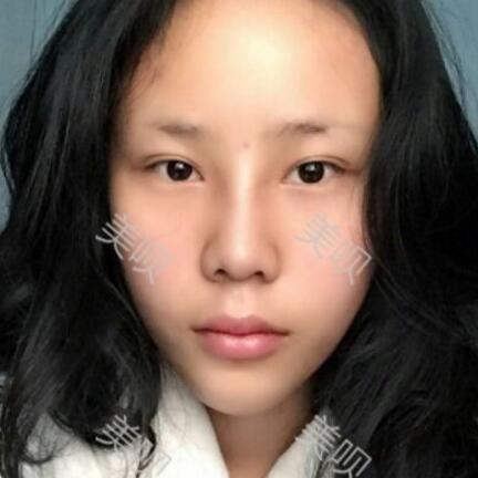 玻尿酸隆鼻前后对比照分享瞬间提升气质了哦