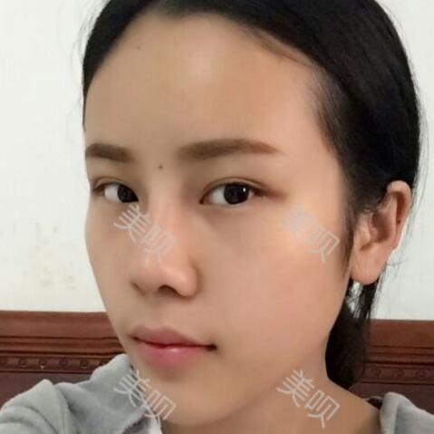 玻尿酸隆鼻前后对比照分享瞬间提升气质了哦