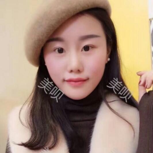 自体脂肪面部填充丰苹果肌和太阳穴之后变年轻了不少哦