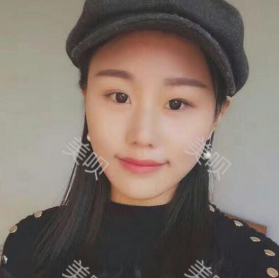 自体脂肪面部填充丰苹果肌和太阳穴之后变年轻了不少哦