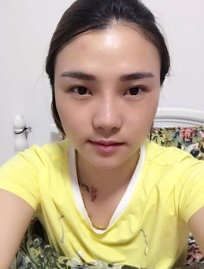 假体隆鼻+鼻翼缩小 前后对比照片