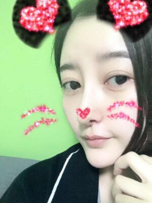 硅胶隆鼻+去眼袋前后对比果十分明X