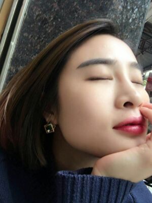 双眼皮失败修复之后疤痕完全没有啦