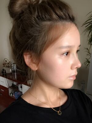 隆鼻和双眼皮修复一起做的，现在气质提升好多