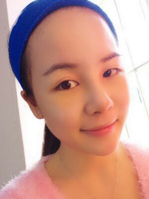 鼻部综合整形真实案例，前后对比图奉上