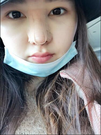 我的隆鼻整形恢复那些小事