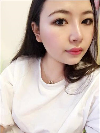 我的隆鼻整形恢复那些小事