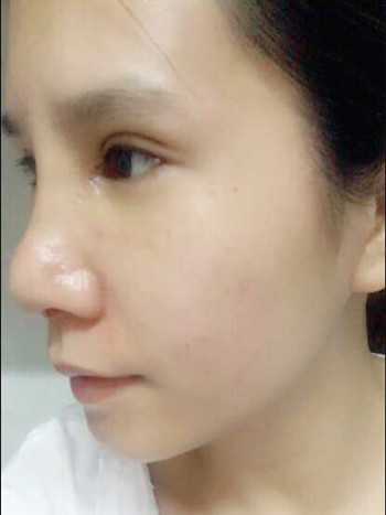 我的双眼皮多项整形+隆鼻整形手术恢复日记 内有对比图哦