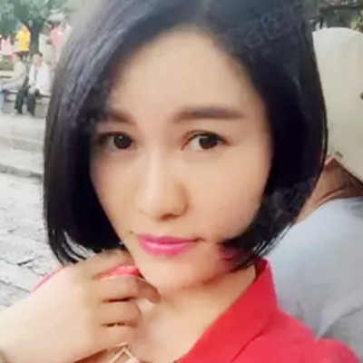 玻尿酸注射鼻子+下巴+太阳穴+苹果肌术后一个月的果照片~