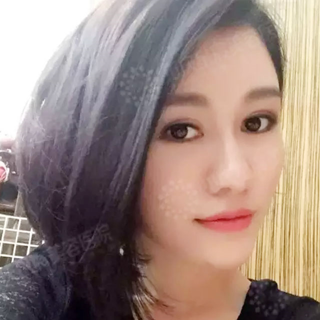 玻尿酸注射鼻子+下巴+太阳穴+苹果肌术后一个月的果照片~