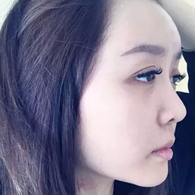 玻尿酸注射隆鼻、自体脂肪丰太阳穴跟玻尿酸垫下巴两个月果照片~