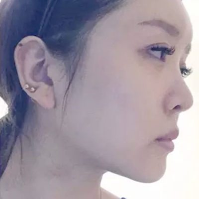 玻尿酸注射隆鼻、自体脂肪丰太阳穴跟玻尿酸垫下巴两个月果照片~