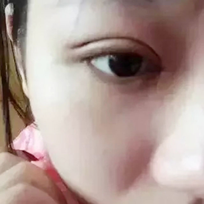 大华韩艺李猛切开双眼皮案例
