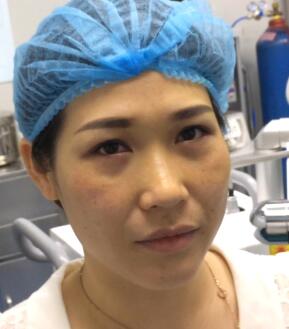 刚做完去眼袋手术照片