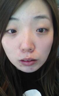 下颌骨整形前的照片