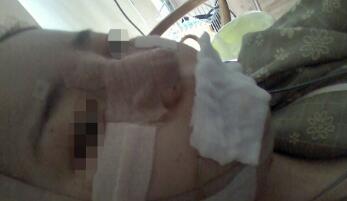 下颌骨整形手术当天