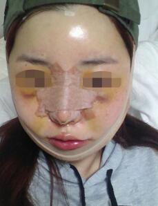 下颌骨整形第五天