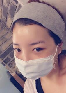 下颌骨整形第十二天，拆线的时候医生手法一如既往的娴熟轻巧