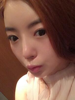 下颌骨整形一个月