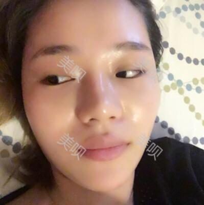 自体脂肪面部填充前后对比照的真实日记分享