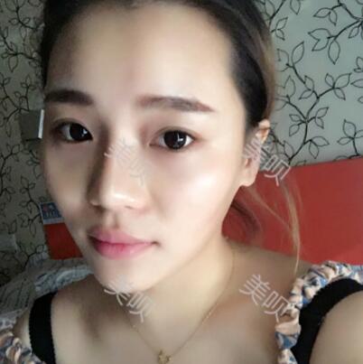 自体脂肪面部填充前后对比照的真实日记分享