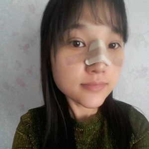 做了假体隆鼻+下巴，简直是丑女大翻身啊