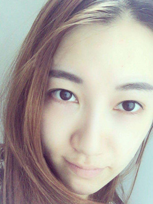 光子嫩肤真实案例分享，果真的还不错哦!