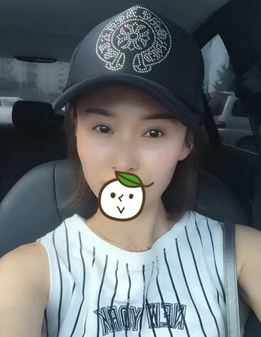 北京丽星双眼皮修复半年了