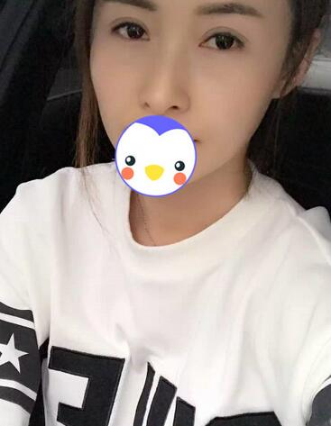 北京丽星双眼皮修复半年了