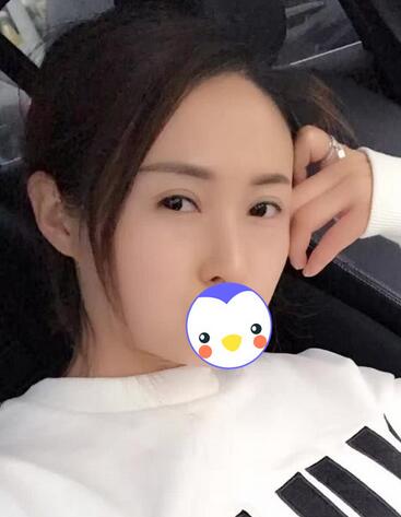 北京丽星双眼皮修复半年了