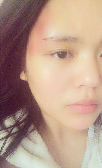 我的自体脂肪面部填充术后果恢复对比图