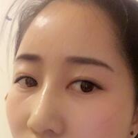 自体脂肪填充太阳穴丰额头亲身经历，多过程恢复图分享