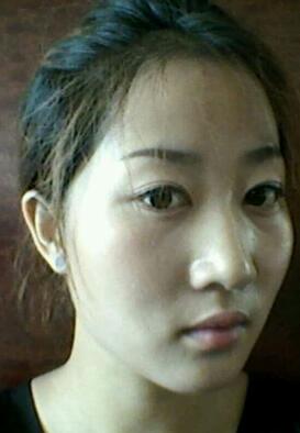 自体脂肪填充术前照片