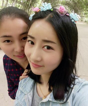 自体脂肪填充太阳穴+额头第五天