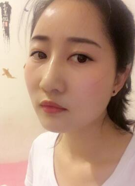 自体脂肪填充太阳穴+额头一个半月