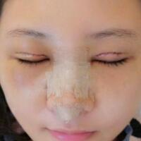 在昆明做了眼睛和鼻子整形，虽然花费了16000元，但人美了就值！