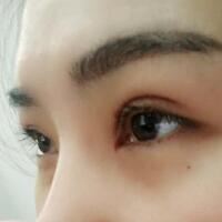 割双眼皮手术价格3200元，单眼皮变双眼皮，去皮去脂，美美的~