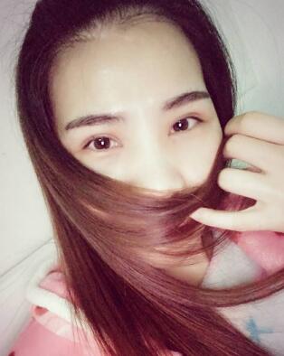 割双眼皮第五天