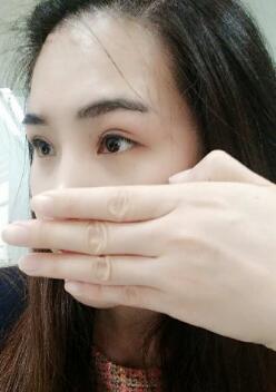 割双眼皮半个月