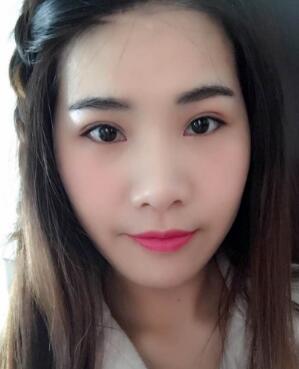 割双眼皮两个月，双眼皮已经完全稳定