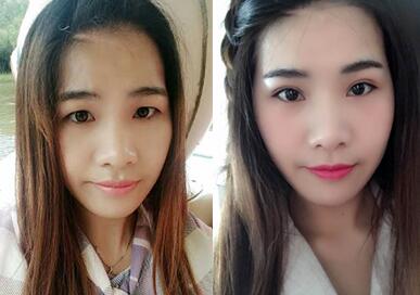 割双眼皮手术前后对比图