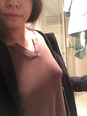 大家看看自体脂肪隆胸恢复果图吧