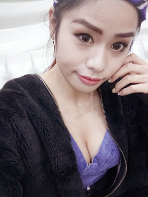 大家看看自体脂肪隆胸恢复果图吧