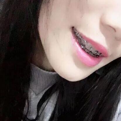 牙齿矫正的真实过程，现在我终于可以露出牙齿放声大笑了