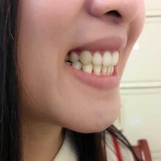 牙齿矫正前后对比照真实过程分享终于不是龅牙妹了哦